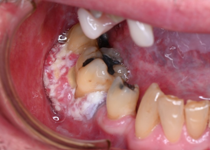Mouth Cancer header image